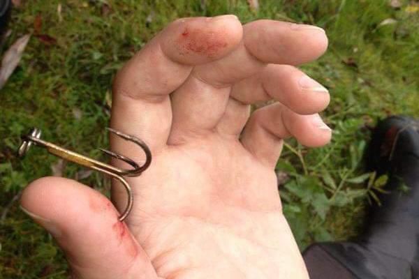 Come rimuovere un gancio bloccato nella mano?
